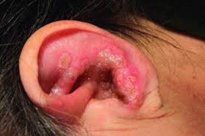 Biến chứng nguy hiểm của bệnh zona tai
